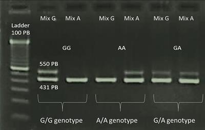 Influence of IL10 (rs1800896) Polymorphism and TNF-α, IL-10, IL-17A, and IL-17F Serum Levels in Ankylosing Spondylitis